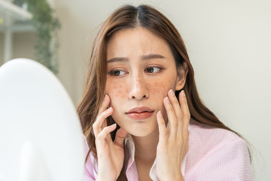 Getting to Know Melasma: What's Causing Those Brown Patches?