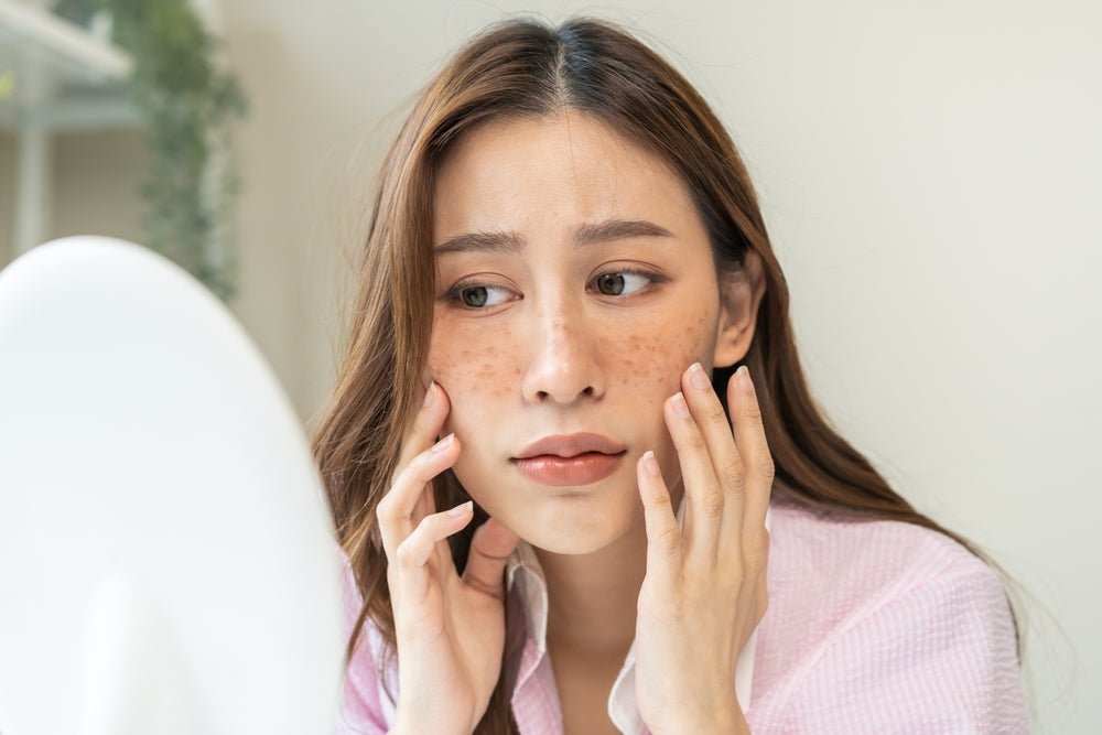 Getting to Know Melasma: What's Causing Those Brown Patches? - LivBalance