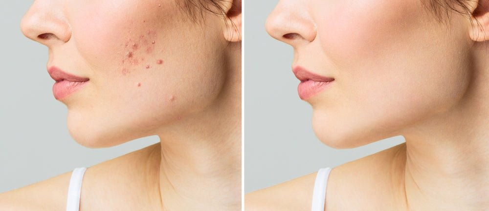 Understanding Acne: Causes, Treatments, and Prevention - LivBalance